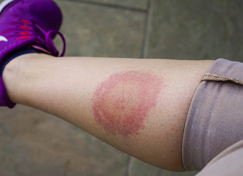 Lyme disease rash or spot